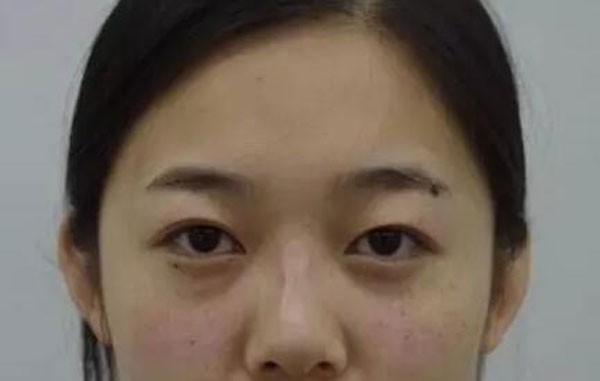 找沈陽安娜寶士麗汪方做雙眼皮2個月很自然，感覺我賺大了