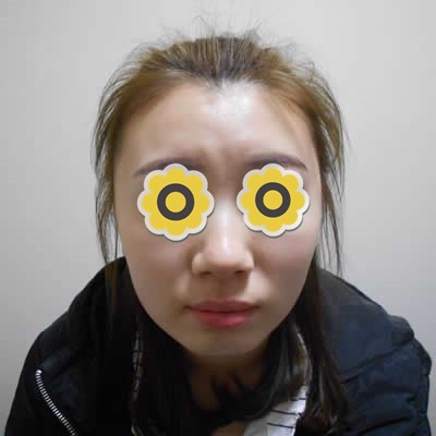 沈陽盛京尚美王超做下巴好嗎？看我玻尿酸墊下巴秒變小v臉