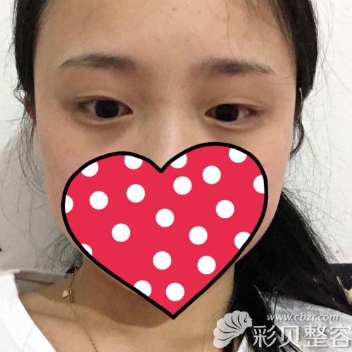 找揭陽華美張旭割雙眼皮術(shù)前的我