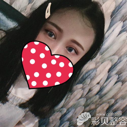 找揭陽華美張旭割雙眼皮術(shù)后30天恢復效果