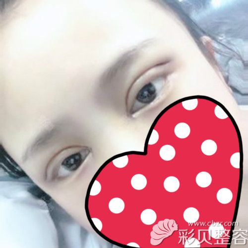 找揭陽華美張旭割雙眼皮術(shù)后第3天