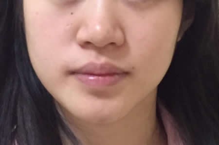 拜托大家來評價張家界依萊美為我做鼻頭鼻翼縮小效果如何