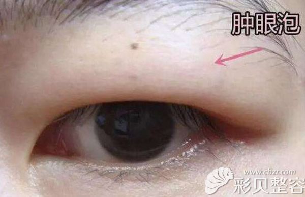 臃腫的眼睛不好看 臃腫的眼睛不好看
