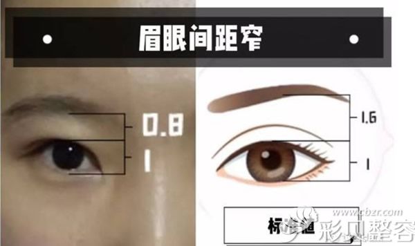 眉眼間距窄和標(biāo)準值示意圖 眉眼間距窄和標(biāo)準值示意圖