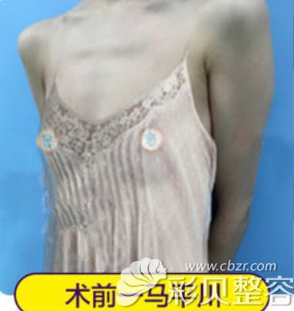 重慶軍科整形醫(yī)院自體脂肪豐胸前