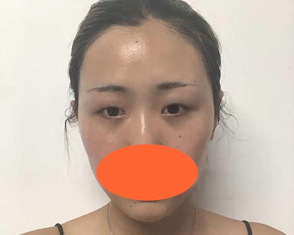 這有深圳非凡王永祥做全切7mm雙眼皮+溶脂去眼袋一年后照片