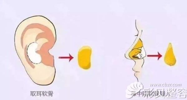 耳軟骨鼻中隔軟骨示意圖 耳軟骨鼻中隔軟骨示意圖