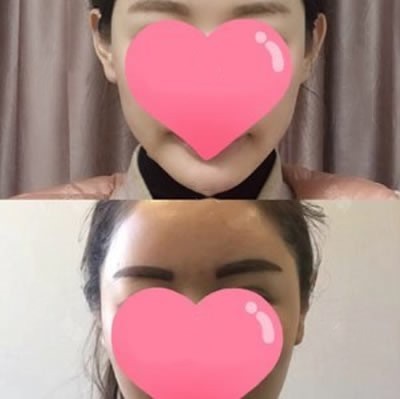 讓韓國普羅菲耳鄭在皓為我做招風耳手術兩年后一點沒反彈