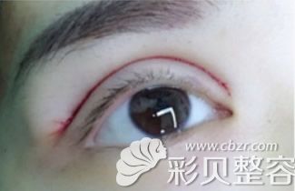程啟院長(zhǎng)割雙眼皮+開(kāi)眼角第二天效果
