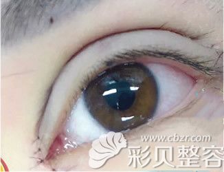 菲凡整形程啟給我做全切雙眼皮第7天拆線后圖片