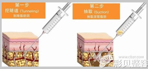 蘭斯吸脂步驟圖