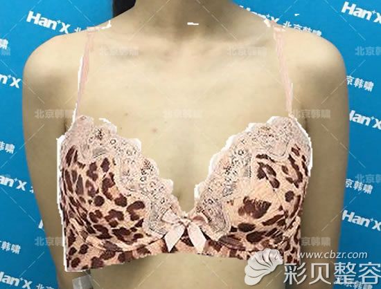 做了9萬(wàn)多的北京韓嘯人工韌帶提胸手術(shù),真的是一分錢一分貨