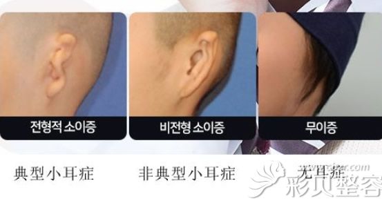 小耳畸形癥狀 小耳畸形癥狀