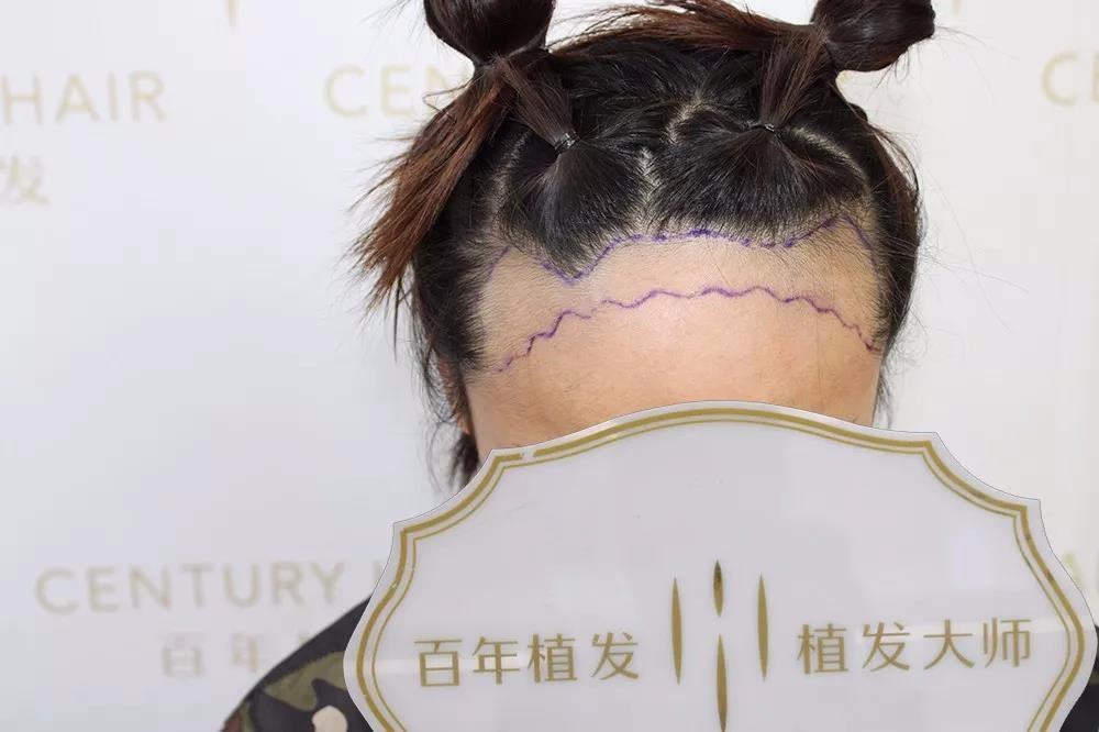 想擁有沉魚(yú)落雁之貌？UST-M種植成就你的美麗夢(mèng)想