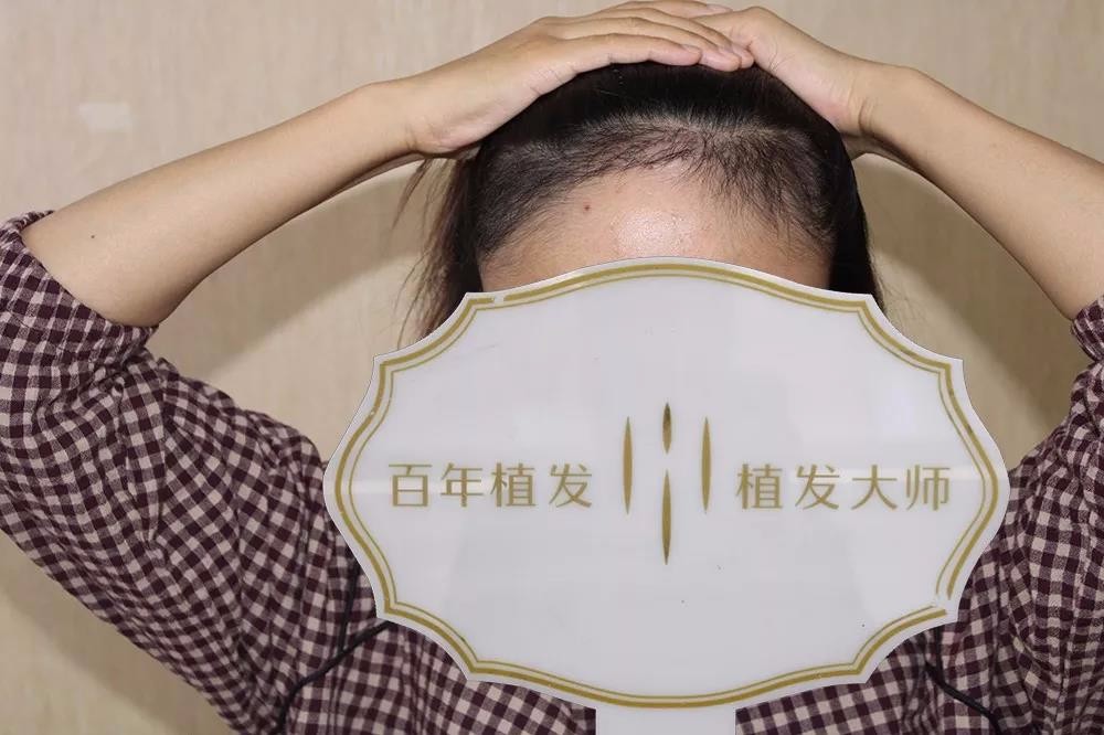 想擁有沉魚落雁之貌？UST-M種植成就你的美麗夢想