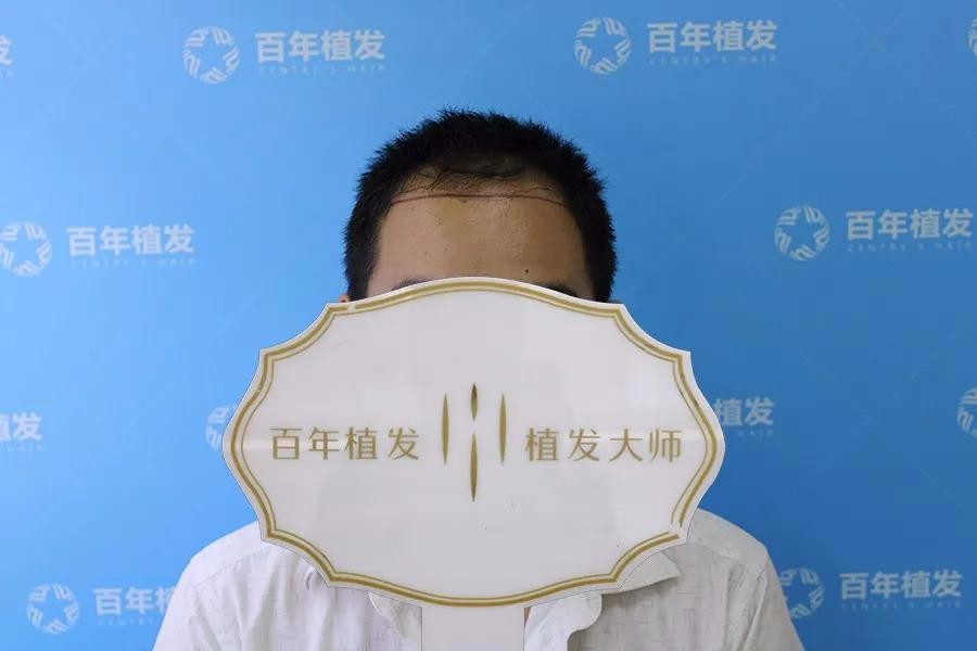 小面積脫發(fā)先別急，不剃發(fā)種植重獲陽(yáng)光形象！