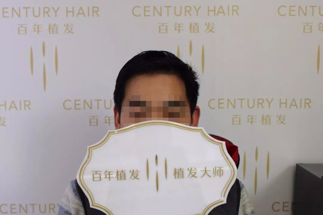 小面積脫發(fā)先別急，不剃發(fā)種植重獲陽光形象！