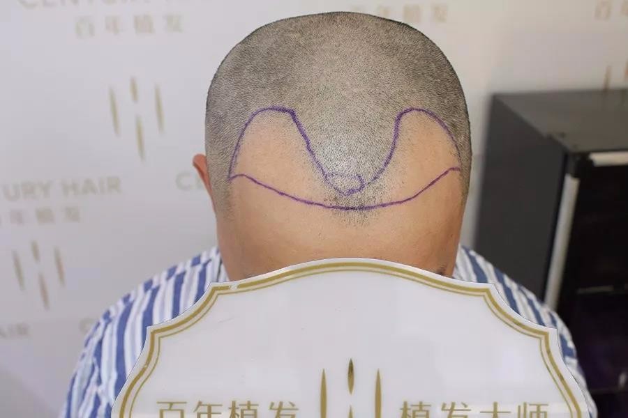 種植密度如何算？額角種植2500單位徹底擺脫M禿