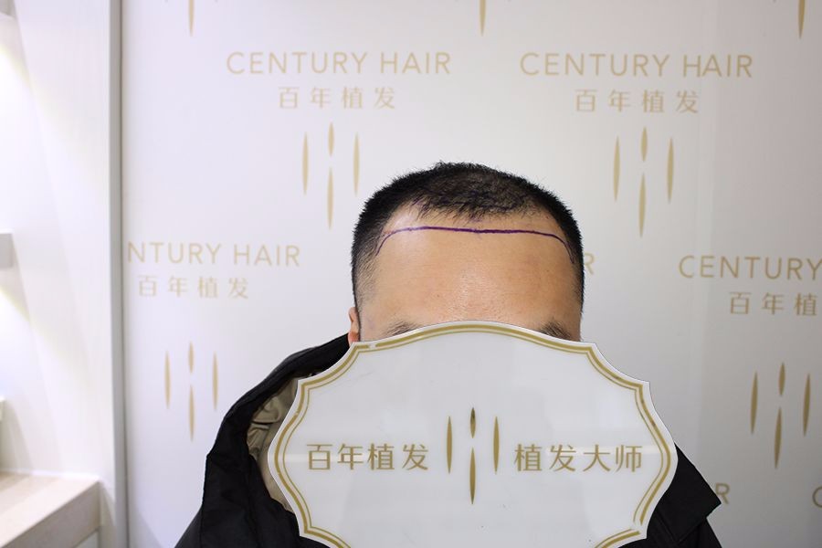 不預(yù)約就直接來(lái)院手術(shù)，迫切改變的他一天也不愿等！