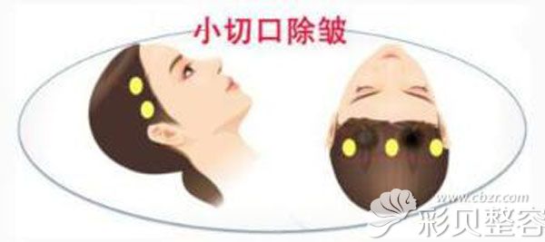 臉部小切口提升的開口在哪 臉部小切口提升的開口在哪