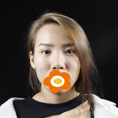 昆明美伊萊整形肋軟骨隆鼻：如愿拯救了我的大鼻子