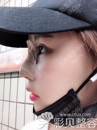 艾恩鼻綜合案例術(shù)后照