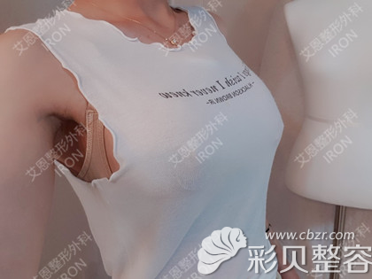 韓國艾恩假體隆胸術(shù)后自然