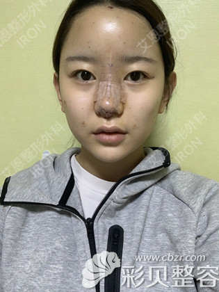 韓國艾恩假體隆鼻術后當天