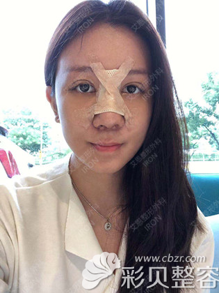 韓國艾恩鼻翼縮小真人案例術(shù)后