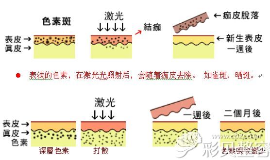 張光澤醫(yī)生講激光美容的原理