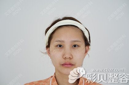 韓國艾恩埋線雙眼皮+鼻綜合+脂肪填充手術(shù)真人案例