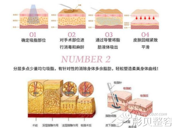 水動力吸脂流程