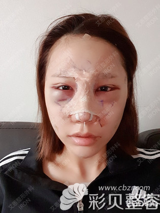 韓國艾恩埋線雙眼皮提肌術(shù)后當天