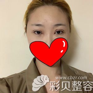 雙眼皮失敗圖片