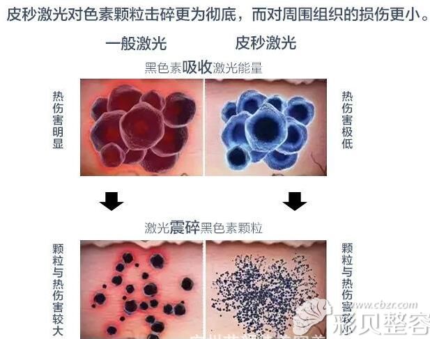 張光澤醫(yī)生分享皮秒激光祛斑的治療效果更<span style=