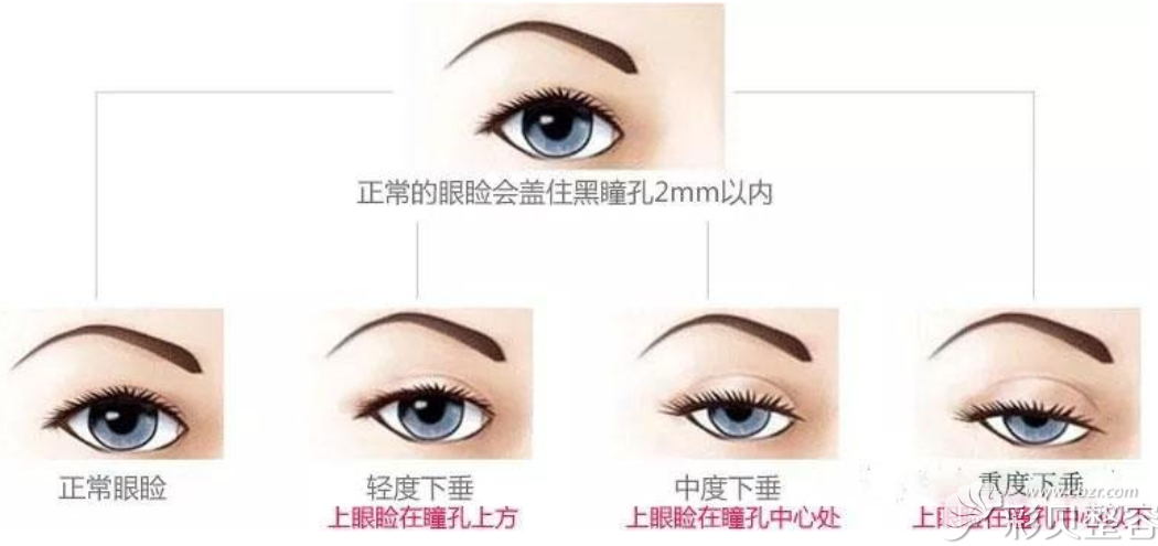 合肥韓美整形醫(yī)院蔡陽春講上瞼下垂程度
