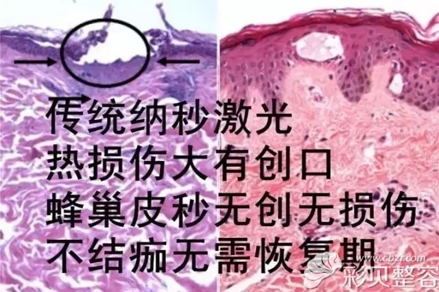 相比于傳統(tǒng)激光，賽諾秀優(yōu)勢明顯