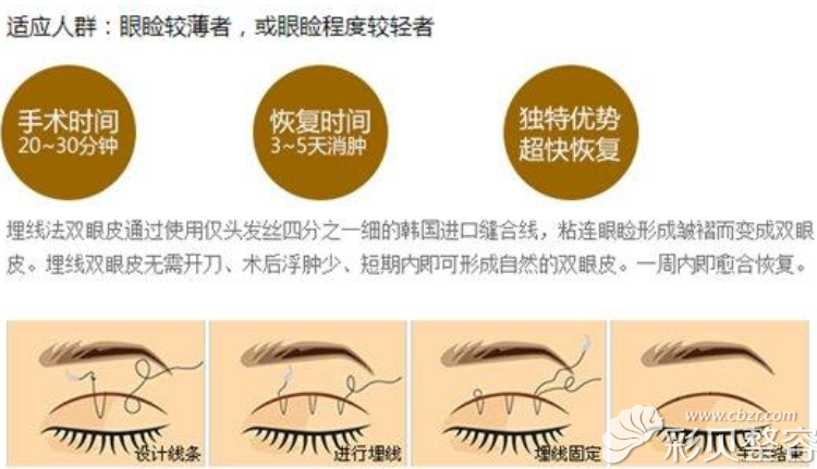 埋線(xiàn)雙眼皮適宜人群
