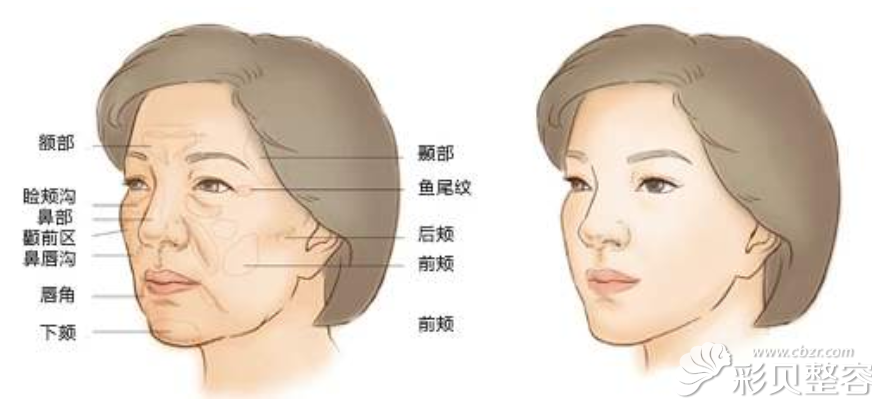 自體脂肪面部填充部位示意圖
