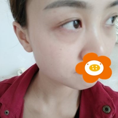 內切祛眼袋手術兩個月恢復過程圖反饋，確實讓我年輕不少!