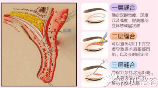 達(dá)美元辰雙眼皮技術(shù)優(yōu)勢 達(dá)美元辰雙眼皮技術(shù)優(yōu)勢