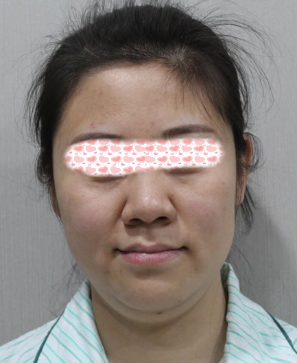 千萬(wàn)別做射頻溶脂瘦臉,術(shù)后15天我雙下巴都沒(méi)了!