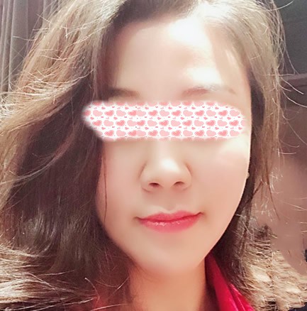 千萬(wàn)別做射頻溶脂瘦臉,術(shù)后15天我雙下巴都沒(méi)了!