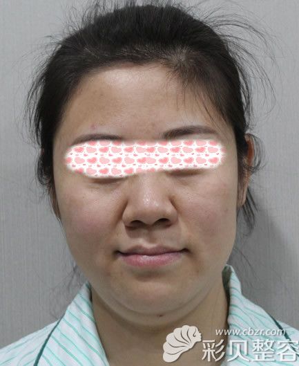 btl射頻溶脂瘦臉和淚溝填充前