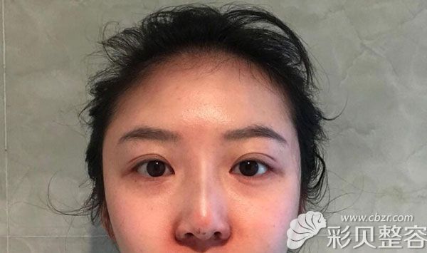 隆鼻第7天拆線鼻頭有點(diǎn)發(fā)紅