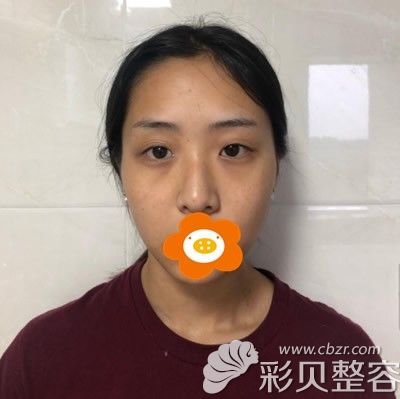 做全切雙眼皮手術前的我