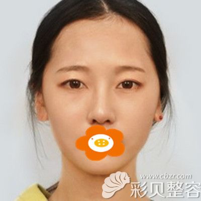 做雙眼皮前的照片