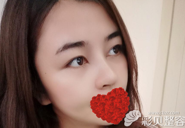 隆鼻2個月沒有出現(xiàn)疤痕增生等后遺癥