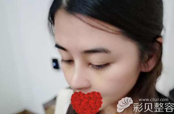 隆鼻后20天的恢復(fù)圖片