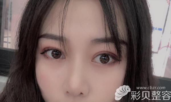 全切雙眼皮15天疤痕有點(diǎn)紅